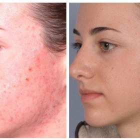 معرفی میکرودرم ابریژن (MicroDerm Abrasion)