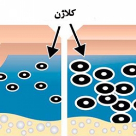 میکرونیدلینگ