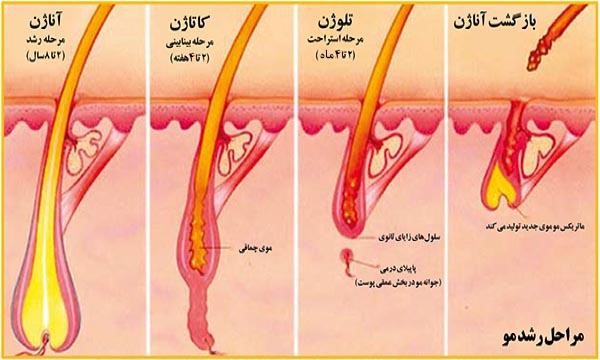 حذف موهای زائد با لیزر